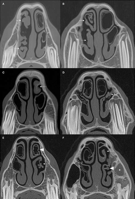 Frontiers Computed Tomographic Assessment Of Individual Paranasal