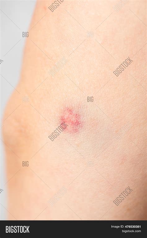 Big Bruise On Girls Image And Photo Free Trial Bigstock
