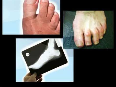 Surgical treatment of hammertoes can vary depending on the surgeon, which toes are involved and severity of deformity. How to Fix Hammer Toe On Children - YouTube