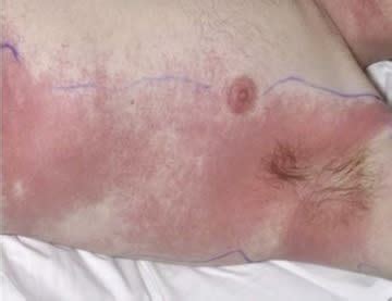 Covid can come with a range of symptoms, from the severe like shortness of breath, to symptoms that but doctors do have a few tips on how to you can tell whether your rash is from covid or not. 'Baboon Syndrome': An Unusual Complication of Antibiotics