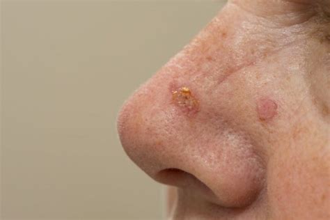 Actinic Keratosis Treatment In Philadelphia And Mainline Pa Dr