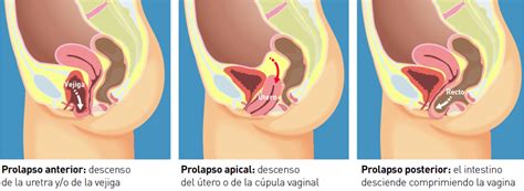 Genital Prolapse Dr Ren Sotelo