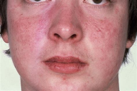 Itchy Face Facial Rash Causes Pictures Treatment