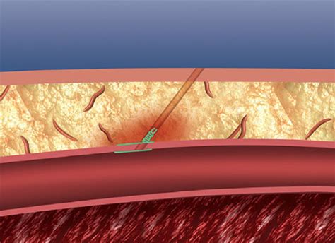 Perclose Proglide Vascular Closure Percutaneous Repair