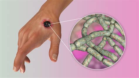 cutaneous anthrax the most common form of anthrax stock illustration illustration of disease