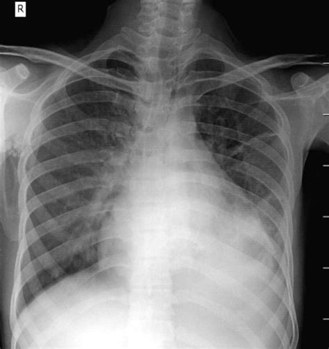 Mitral Stenosis Radiology Reference Article