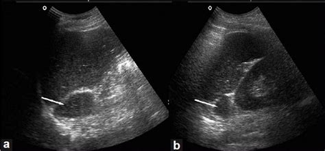 Wk 3 Adrenal Glands Ultrasonography Of The Abdomen Revealing Right A