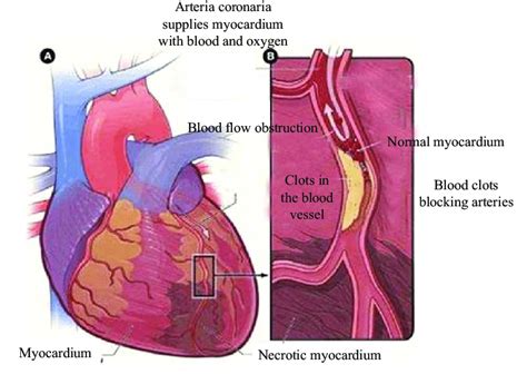 Schematic Diagram Of Acute Myocardial Infarction Download Scientific