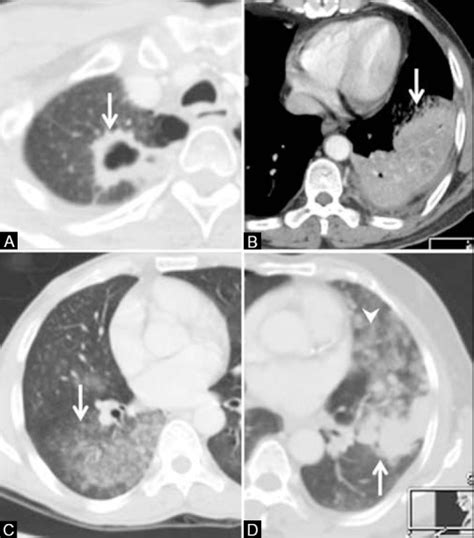 Lung Cancer Ct Scan Wikidoc