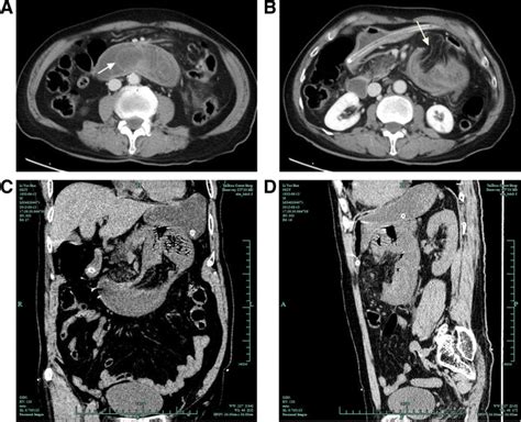 Paraduodenal Hernia Complicated With Intussusception Case Report Bmc