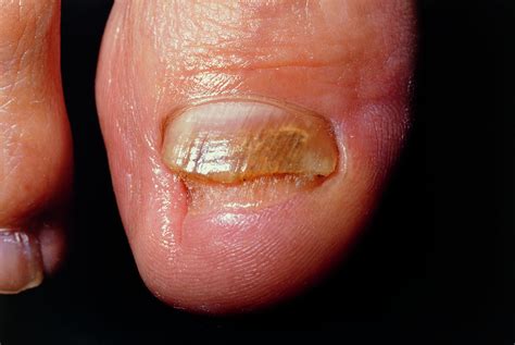 Chronic Fungal Infection Of Toes Photograph By Dr Hcrobinson