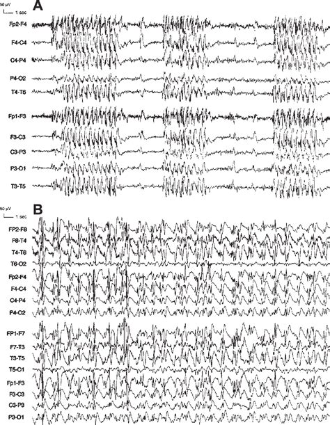 Figure 1 From Absence And Myoclonic Status Epilepticus Precipitated By