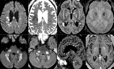 Multi Institutional Study Looks At Brain Mri Findings In Covid 19