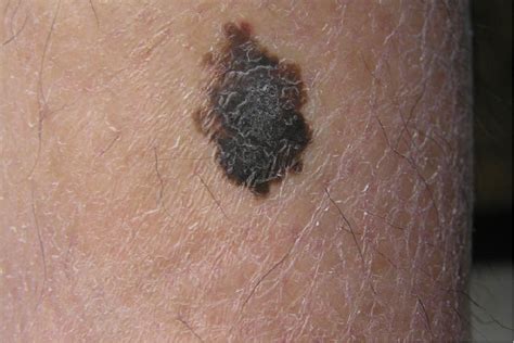 Types Of Melanoma Skin Cancer