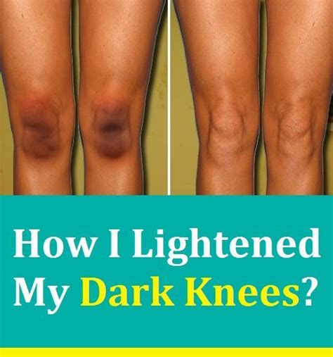 Dark Knees What Causes Them And How To Lighten Your Knees How To