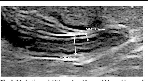 Ultrasound Of The Pediatric Appendix Semantic Scholar