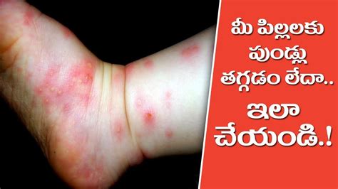 Tips For Treating Your Childs Wounds At Home Telugu Village Health