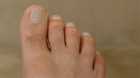 🔥 Video Of The Feet And Toes Of A Manathletes Foot Disease Itchy