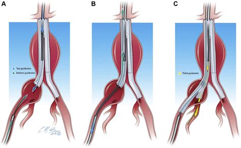 Combined Transbrachial And Transfemoral Strategy To Deploy An Iliac