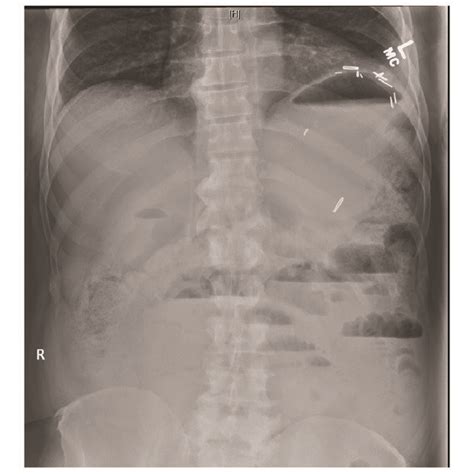 Abdominal X Ray Showing Scattered Air Fluid Levels In Minimally