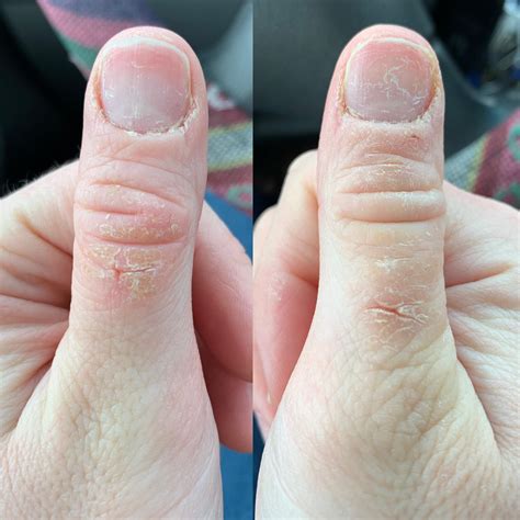 Itchy Scaly Spots On Both Thumbs And Sometimes Other Hand And Toe