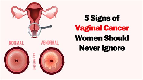 5 Signs Of Vaginal Cancer Women Shouldnt Ignore Womenworking