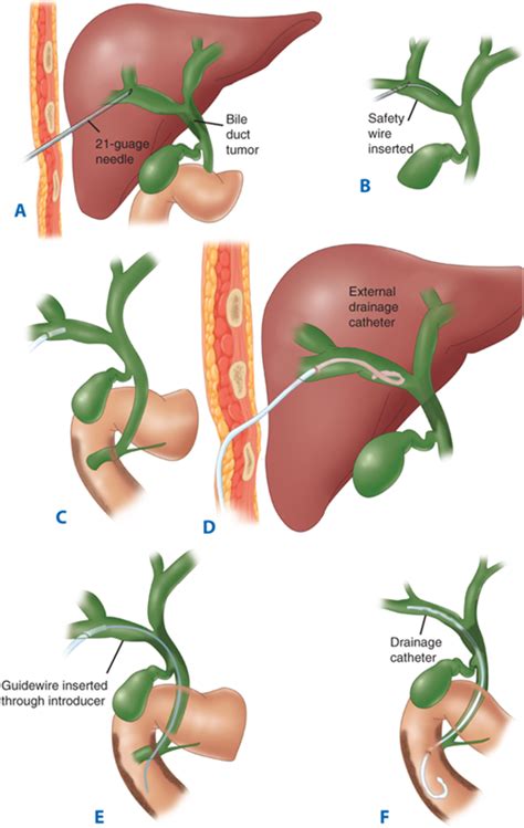Gallbladder And The Extrahepatic Biliary System Basicmedical Key