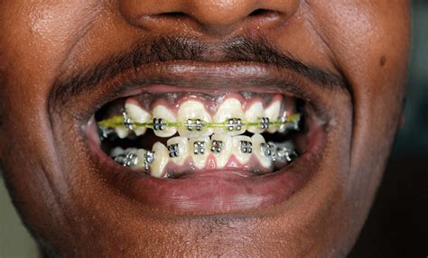 How Much Do Braces Cost In South Africa At Matthew Ybarra Blog