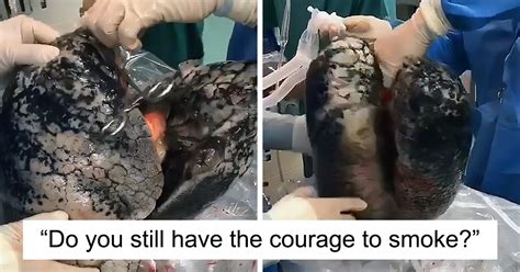 Food and drug administration, silver spring, maryland. Surgeons Show What The Human Lungs Look Like After 30 Years Of Smoking & It's Shocking | Bored Panda