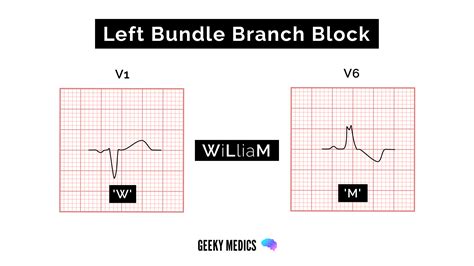 Bundle Branch Block Lbbb Rbbb Geeky Medics