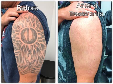 Alka Skin Laser Clinic Understand Skin Types And Laser Tattoo Removal