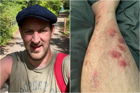 Giant Hogweed Warning As Glasgow Dad Suffers Third Degree Burns From