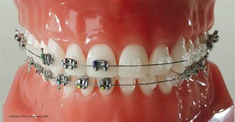 Metal Vs Clear Braces Dr Ahmad Bioumy Orthodontic Clinic 42 Abbas