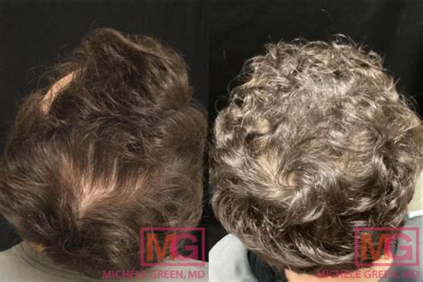 Does Ozempic Cause Hair Loss Bss News