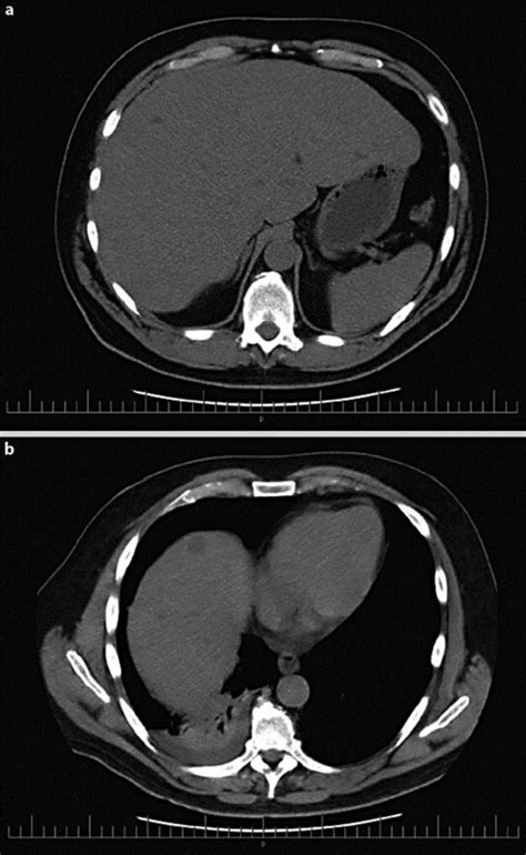 Ct Scan A Diffuse Nodular Liver B Lesions In A Liver With Poor