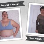 Before After Gastric Bypass With Skotti Losing Pounds Obesityhelp