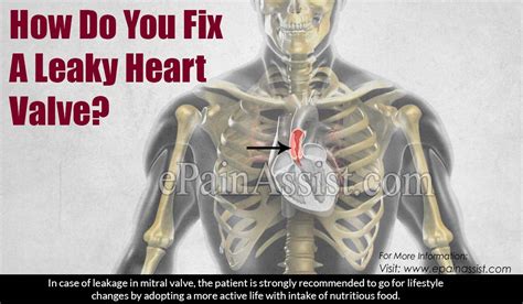 How Do You Fix A Leaky Heart Valve