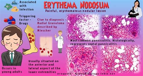Pathology Of Erythema Nodosum Erythema Nodosum Emergency Medicine