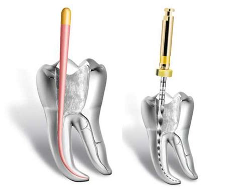 Instrumentos Rotatorios En Tratamientos De Conducto Clínica Dentiláser