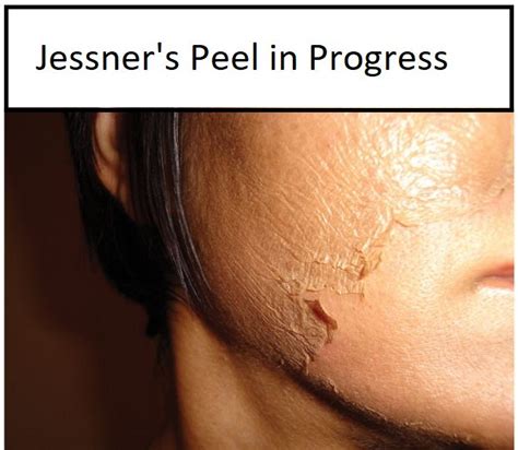 So What Can Jessner Peel Do For You Skin Well Quite A Lot Actually
