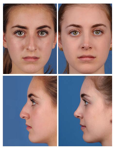 Bulbous Nose Job Nose Tip Surgery In Turkey Top 3 Clinics Prices