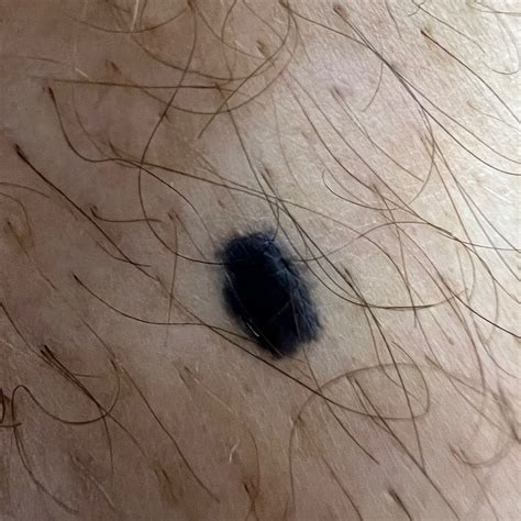 Understanding The Different Types Of Moles Spot Check Clinic 2022