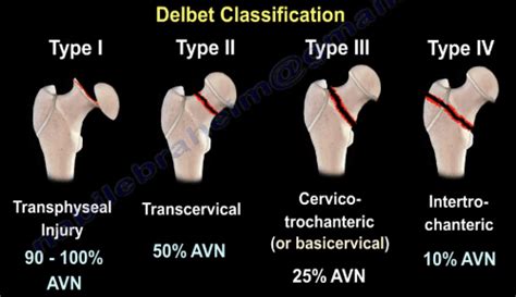 Avn Of The Femoral Head Causes Trauma To The Hip Healthcare