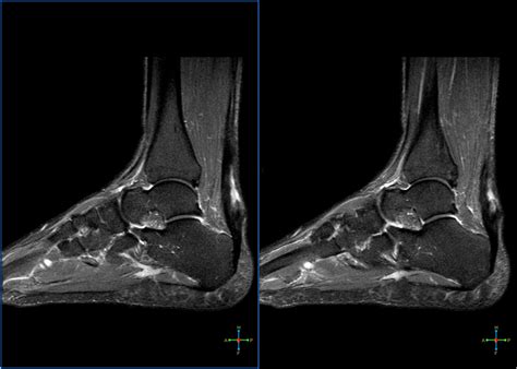 Partial Tears Of Achilles Tendon Radrounds Radiology Network