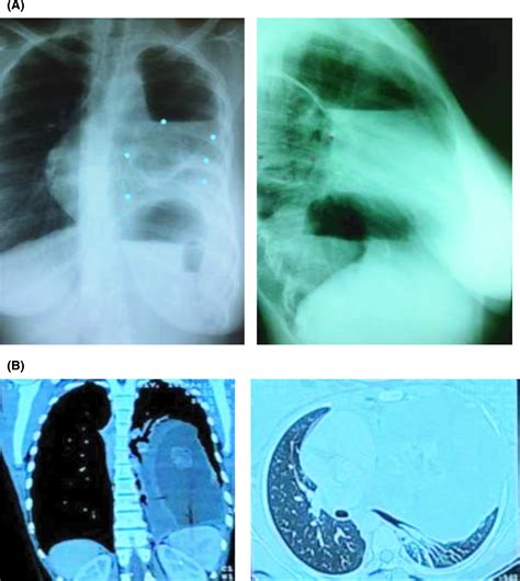 Mediastinal Cystic Teratoma Misdiagnosed As Pleural Tuberculosis A