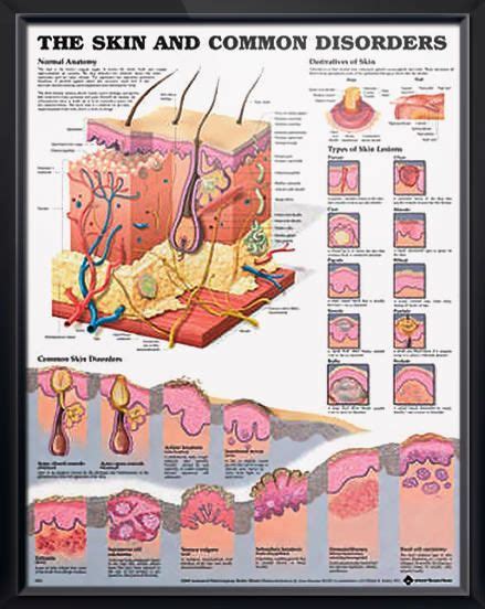 The Skin And Common Disorders Anatomy Poster Vividly Depicts Cross