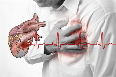 Ataque Cardíaco O Que é Sintomas Causas E Tratamentos