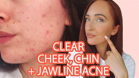 How To Get Rid Of Chin Cheek Jawline Acne Tips For Balancing