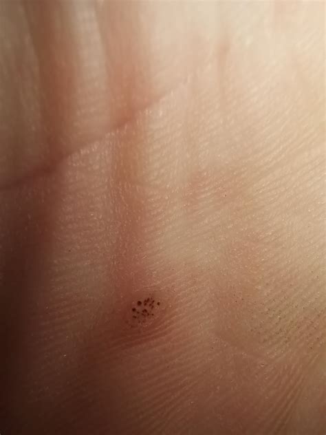 What Is This Thing On The Palm Of My Hand Rdermatologyquestions