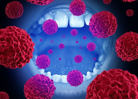 Oral Cancer Be Careful Of These Risk Factors
